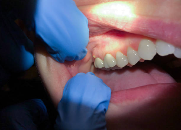 Best Emergency Dentist for Lost Fillings or Crowns in Gregory, TX